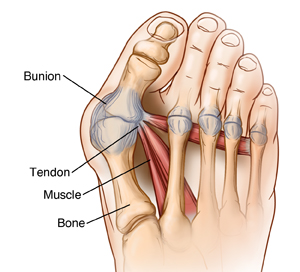 hallux bunion corrector instructions how to put them on pdf