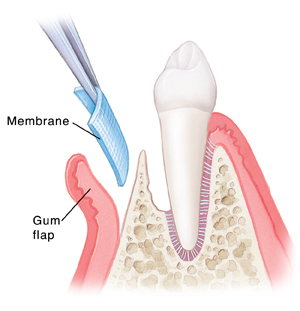 Surgery on gum and bone Membrane being placed in gum flap next to tooth.
