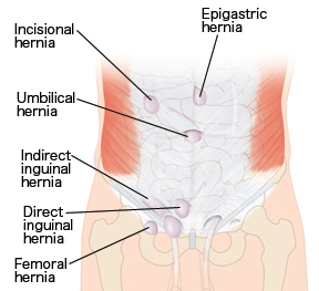 what is a hernia sterling care in home care westchester ny in how do hernias form