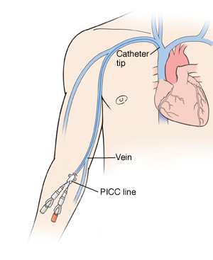 Picc Line Skin Care Picc Line Skin Care