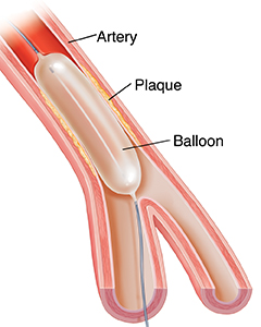 coronary angioplasty sterling care in home care westchester ny