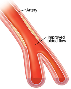 coronary angioplasty sterling care in home care westchester ny